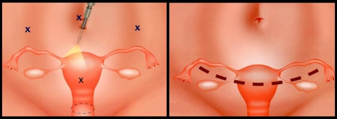 Laqueadura Tubária - Instituto Feminina - Cirurgia ginecológica