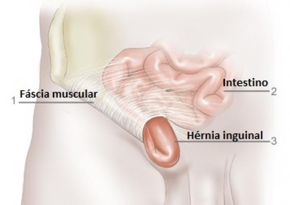 O que pode dar errado na Cirurgia de Hérnia Inguinal? • Café Cirúrgico