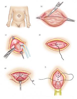 Cinco dicas para a recuperação da cirurgia de hérnia epigástrica - SBH